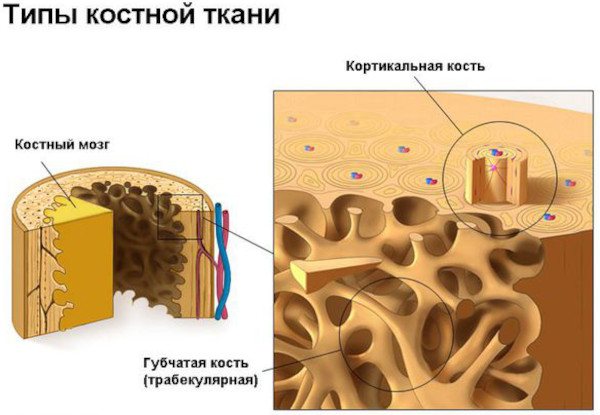 Остеопороз пятнистый: кости на рентгенограмме, КТ, что это такое, лечение