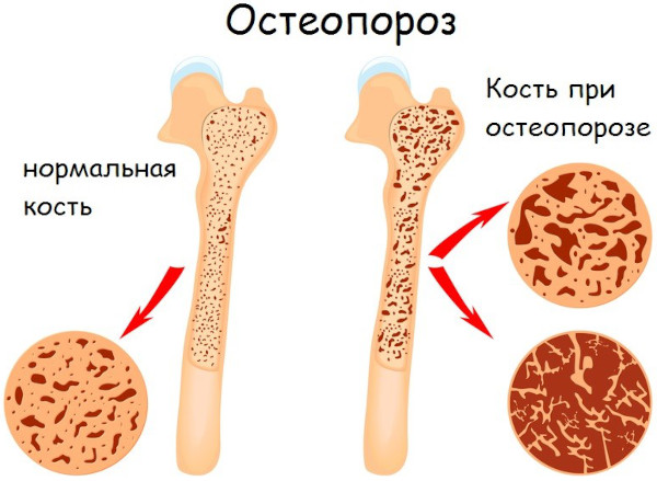 Остеопороз пятнистый: кости на рентгенограмме, КТ, что это такое, лечение