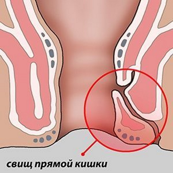 Острый парапроктит. Операция, лечение воспаления возле ануса