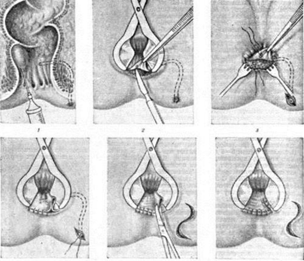 Острый парапроктит. Операция, лечение воспаления возле ануса