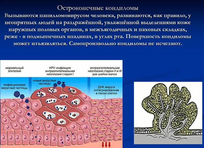 Перианальные кондиломы (остроконечные в перианальной области). Фото, лечение