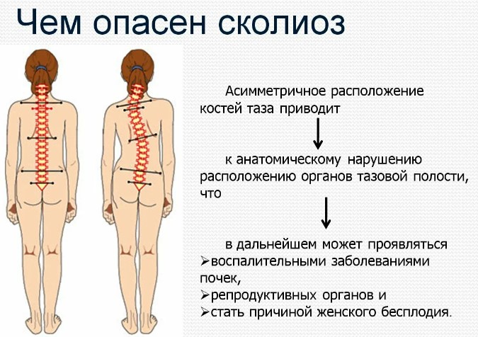 Плавание при остеохондрозе шейном, поясничного отдела позвоночника, грудном. Польза