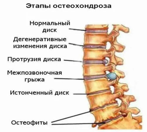 Полисегментарный остеохондроз позвоночника. Что это такое, степени