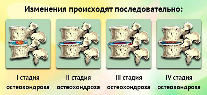 Полисегментарный остеохондроз позвоночника. Что это такое, степени