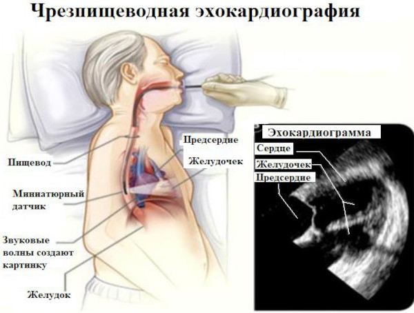 Пролапс аортального клапана 1-2 степени. Что это, симптомы