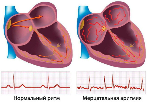 Пролапс аортального клапана 1-2 степени. Что это, симптомы