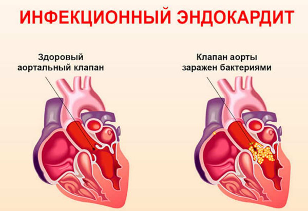 Пролапс аортального клапана 1-2 степени. Что это, симптомы