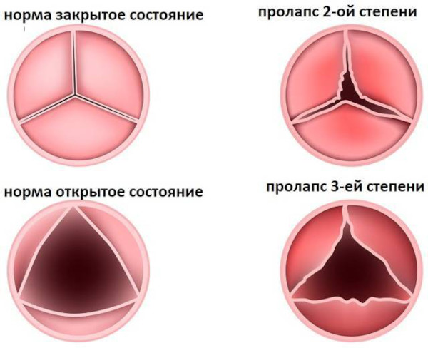 Пролапс аортального клапана 1-2 степени. Что это, симптомы