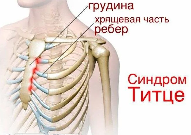 Синдром Титце. Симптомы, причины и лечение