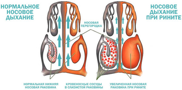 Слабые сосуды в носу. Лечение, чем укрепить