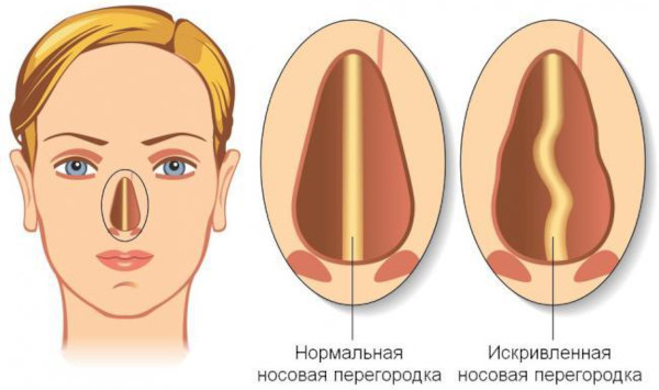 Слабые сосуды в носу. Лечение, чем укрепить