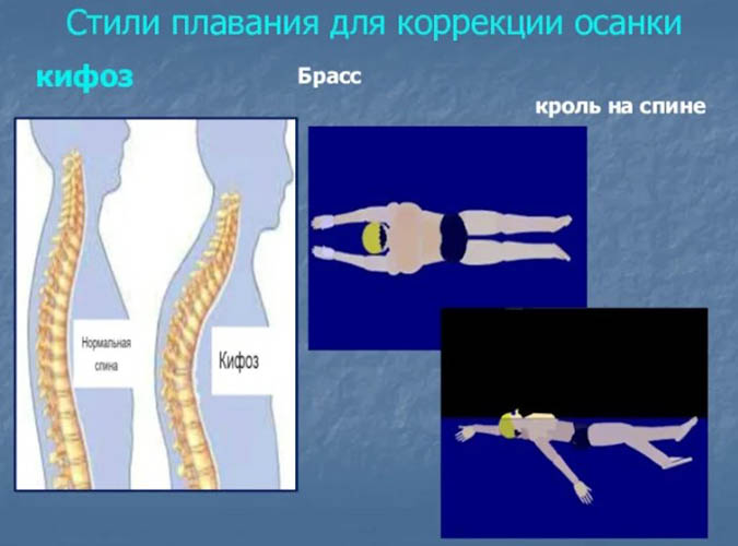 Сутулость (кифоз). Как убрать, исправить нарушение осанки у взрослого, ребенка