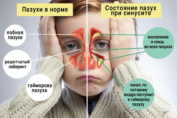 Температура при синусите у ребенка, взрослого, 37 долгое время