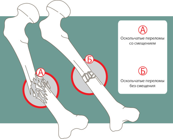 Виды переломов костей (нарушение целостности). Первая помощь, лечение