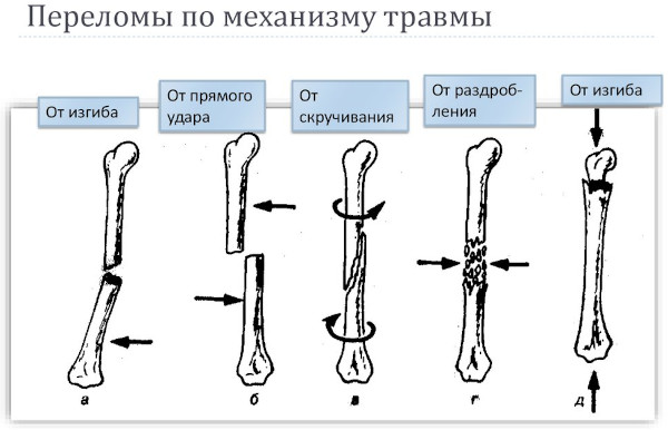 Виды переломов костей (нарушение целостности). Первая помощь, лечение