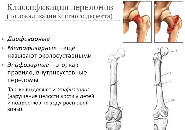 Виды переломов костей (нарушение целостности). Первая помощь, лечение