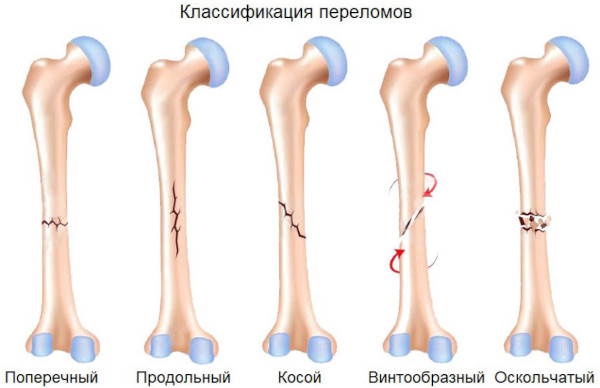 Виды переломов костей (нарушение целостности). Первая помощь, лечение