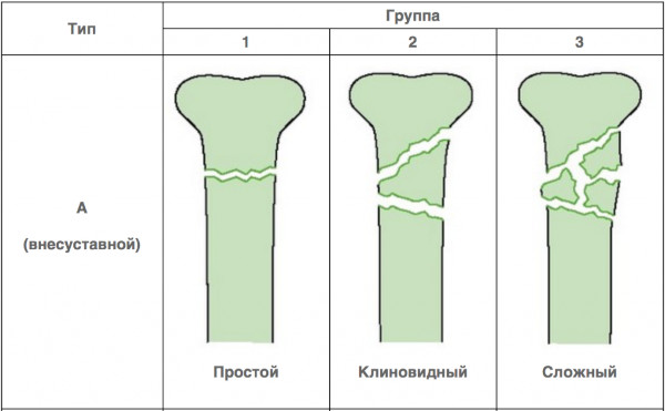 Виды переломов костей (нарушение целостности). Первая помощь, лечение