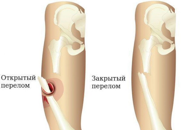 Виды переломов костей (нарушение целостности). Первая помощь, лечение