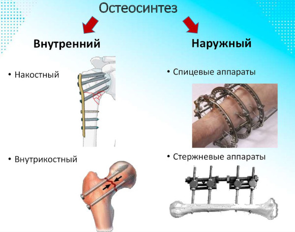 Виды переломов костей (нарушение целостности). Первая помощь, лечение