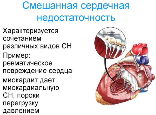 Виды сердечной недостаточности. Классификация по механизмам возникновения