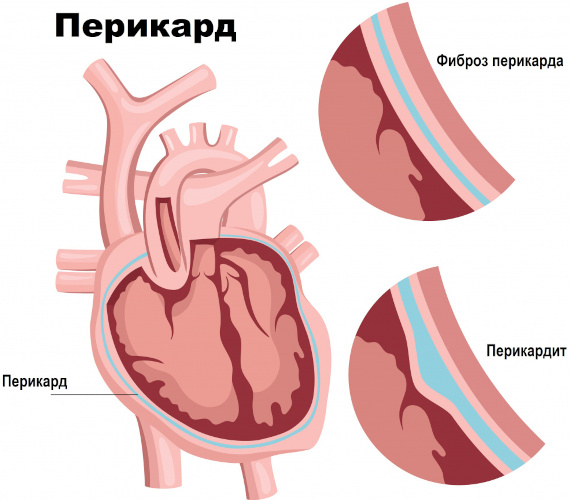 Виды сердечной недостаточности. Классификация по механизмам возникновения