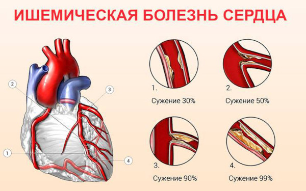 Виды сердечной недостаточности. Классификация по механизмам возникновения