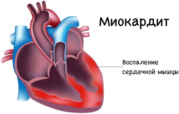 Виды сердечной недостаточности. Классификация по механизмам возникновения