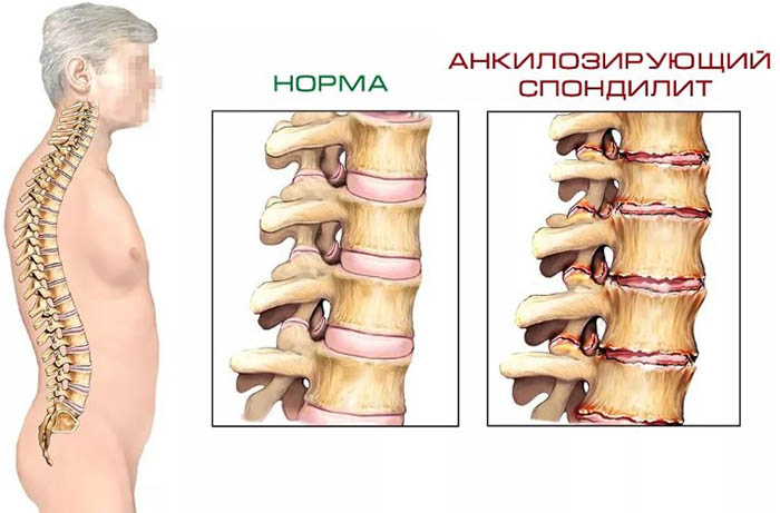 Заболевания позвоночника. Названия болезней, список, симптомы и лечение