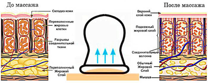 Баночный вакуумный массаж спины аппаратный. Для чего, как ставят банки