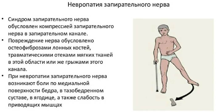 Невропатия нижних конечностей. Что это, симптомы, лечение