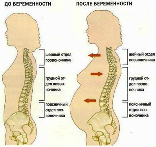 Остеохондроз при беременности. Симптомы, что делать, лечение