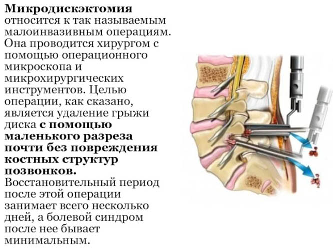 Перекос таза. Симптомы, упражнения для нормализации положения