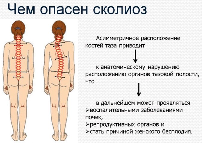 Сколиоз 3 степени. Фото, лечение позвоночника, ЛФК упражнения