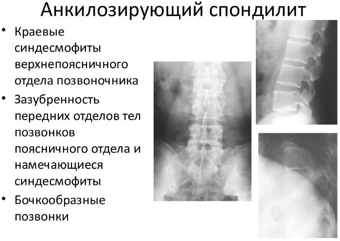 Баланопостит члена фото