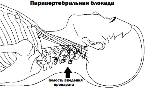 Блокада при остеохондрозе шейного отдела позвоночника. Последствия, отзывы