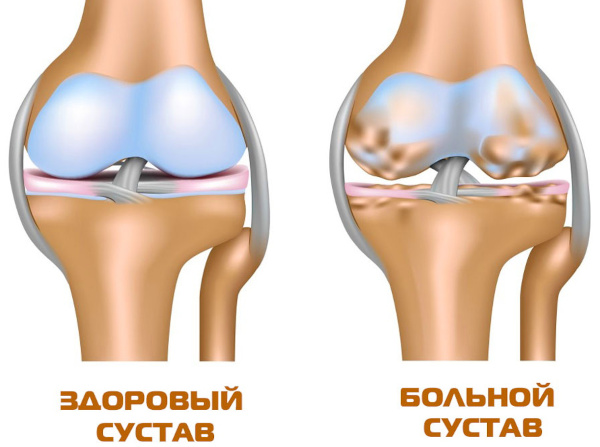 Диета при артрозе коленного сустава. Меню на неделю, продукты