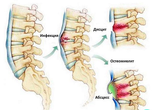 Дисцит позвоночника. Что это такое, лечение, антибиотики