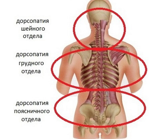 Дорсопатия грудного отдела позвоночника. Что это такое