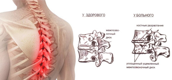 Дорсопатия грудного отдела позвоночника. Что это такое