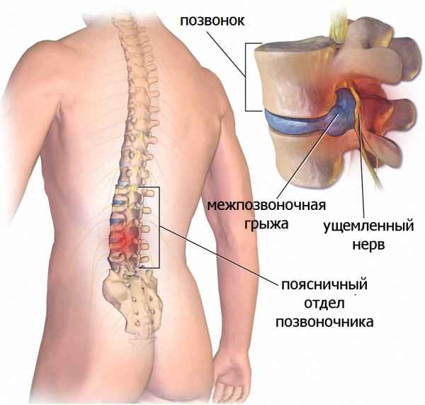 Дорсопатия пояснично-крестцового отдела позвоночника. Лечение