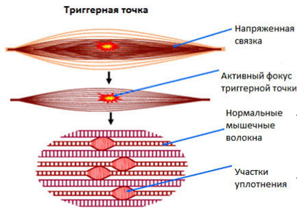 Дорсопатия пояснично-крестцового отдела позвоночника. Лечение