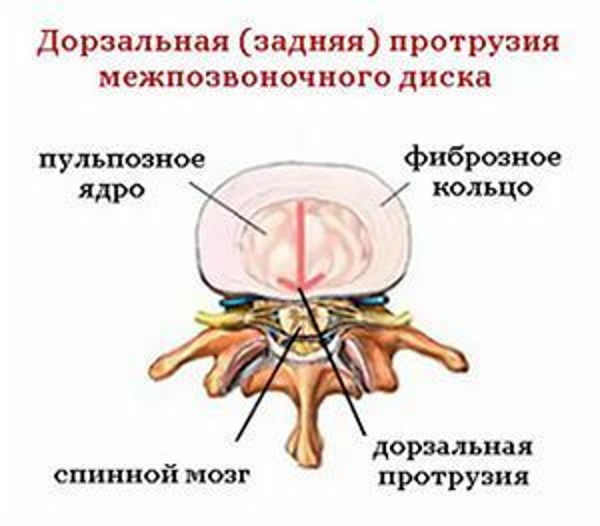 Дорзальная протрузия диска, межпозвонковых дисков. Что это