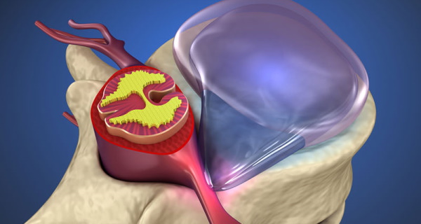 Дорзальная протрузия диска, межпозвонковых дисков. Что это