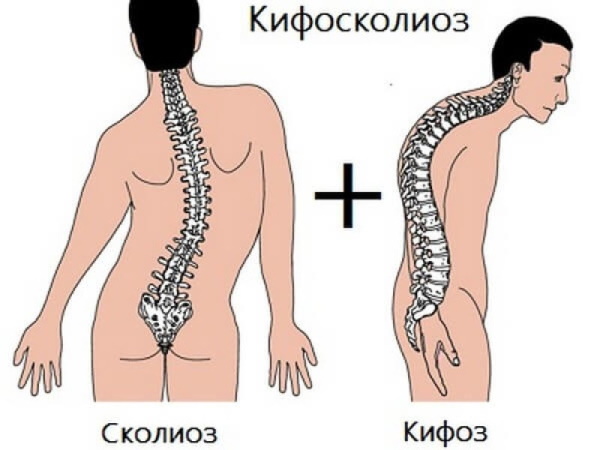 Кифосколиоз грудного отдела позвоночника. Что это, степени, упражнения