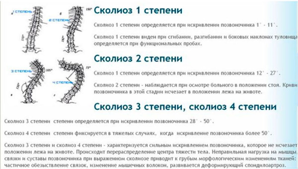 Кифосколиоз грудного отдела позвоночника. Что это, степени, упражнения