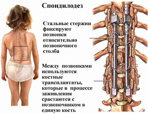 Кифосколиоз грудного отдела позвоночника. Что это, степени, упражнения