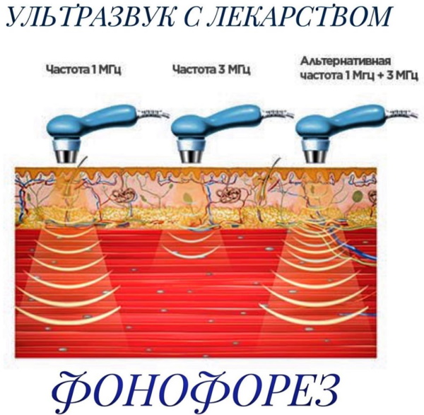 Компрессия позвоночника, позвонков. Что это такое, компрессионный синдром