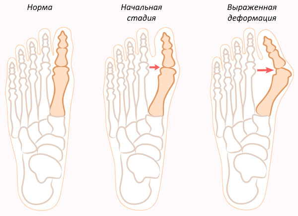 Метатарзалгия стопы. Что это такое, симптомы, лечение