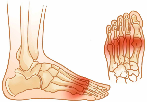 Метатарзалгия стопы. Что это такое, симптомы, лечение